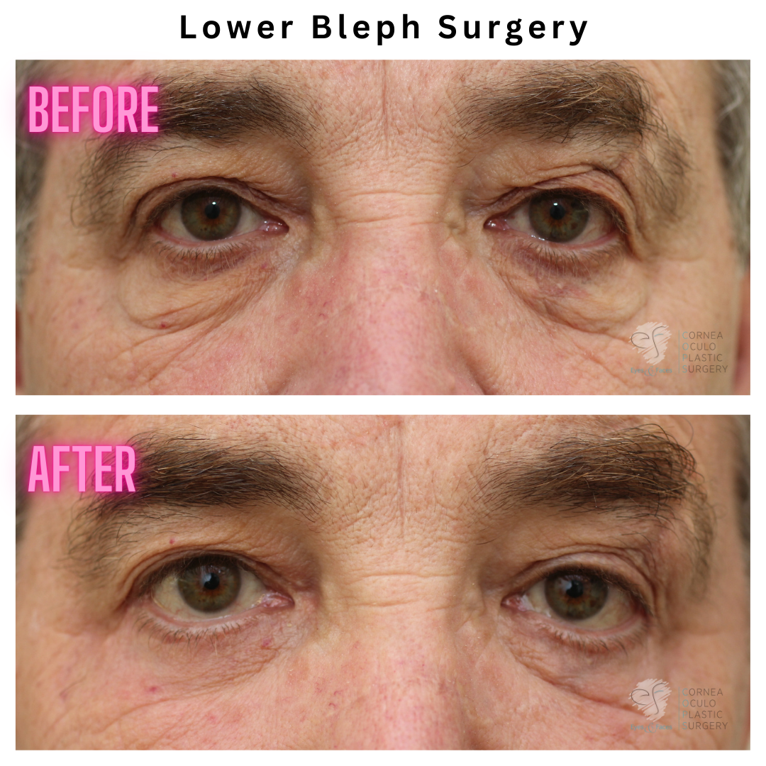 Lower eyelid surgery performed by Dr Anthony Maloof. Before and after image of lower bleph or blepharoplasty.