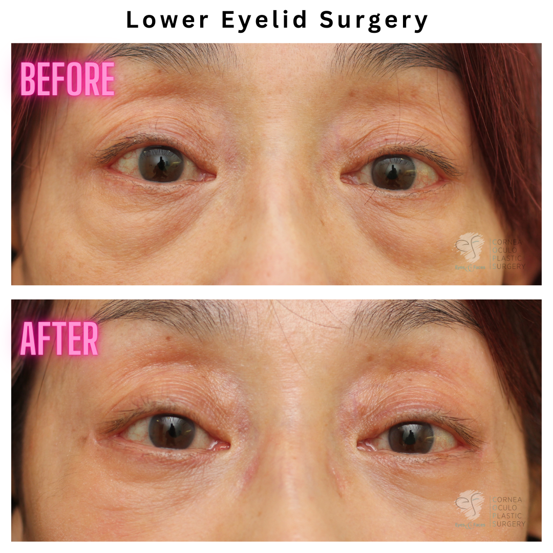 Lower eyelid surgery performed by Dr Anthony Maloof. Before and after images.
