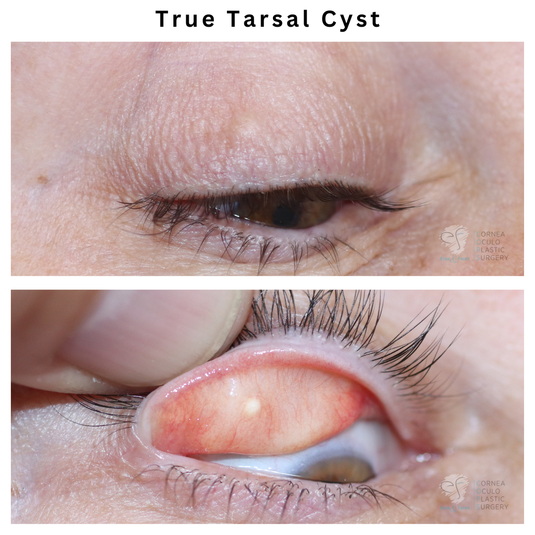 True Tarsal Cyst - not a chalazion - Dr Anthony Maloof