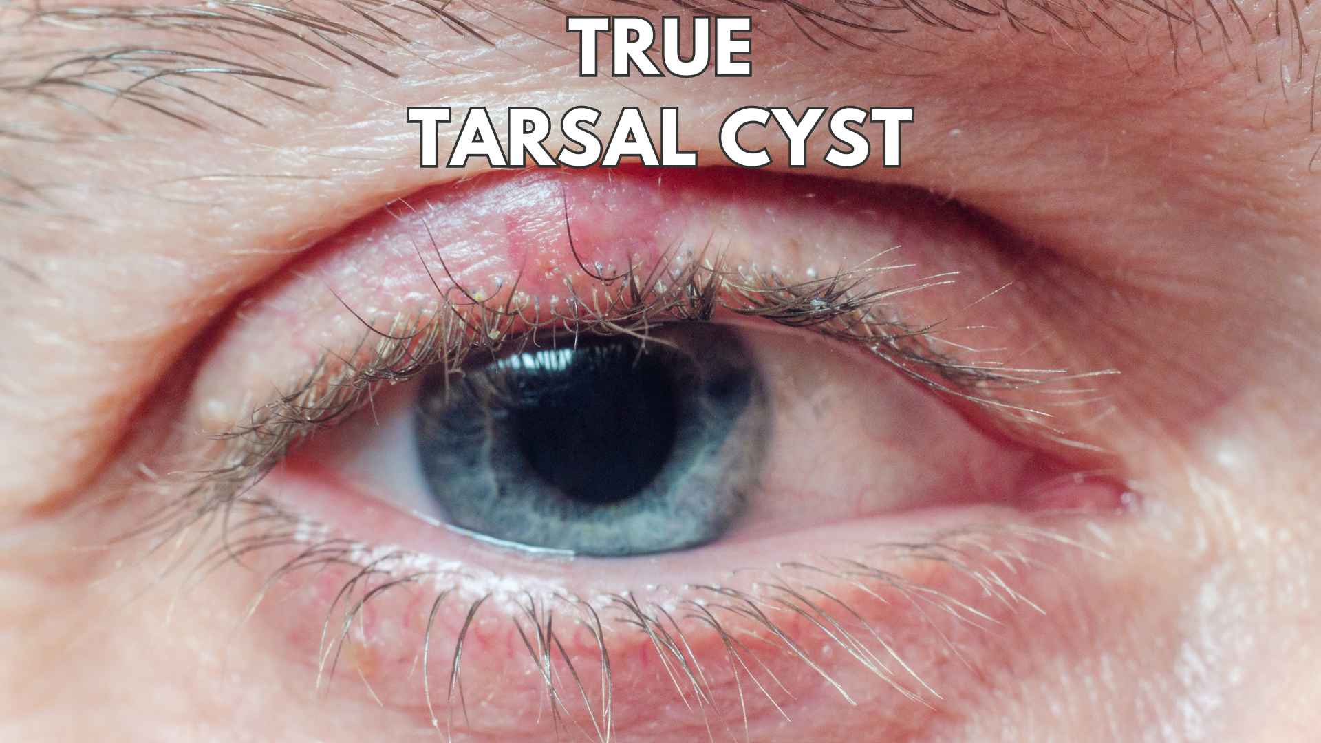 True tarsal cyst - not a chalazion - Dr Anthony Maloof